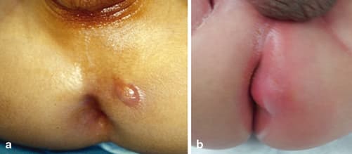 Ilustração de abscesso perianal em bebê