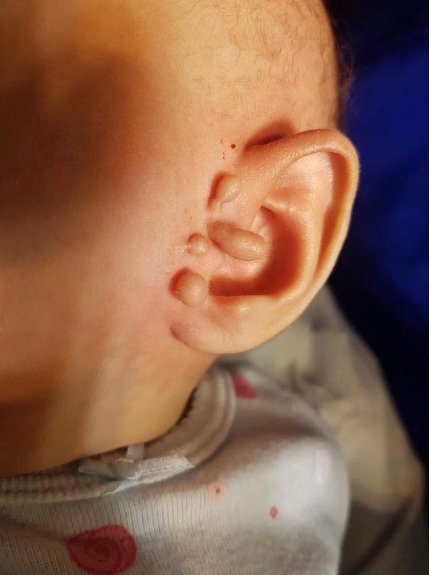 Apêndice pré-auricular em bebê, na frente da orelha