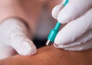 Biópsia de pele: coleta delicada do fragmento com instrumento próprio