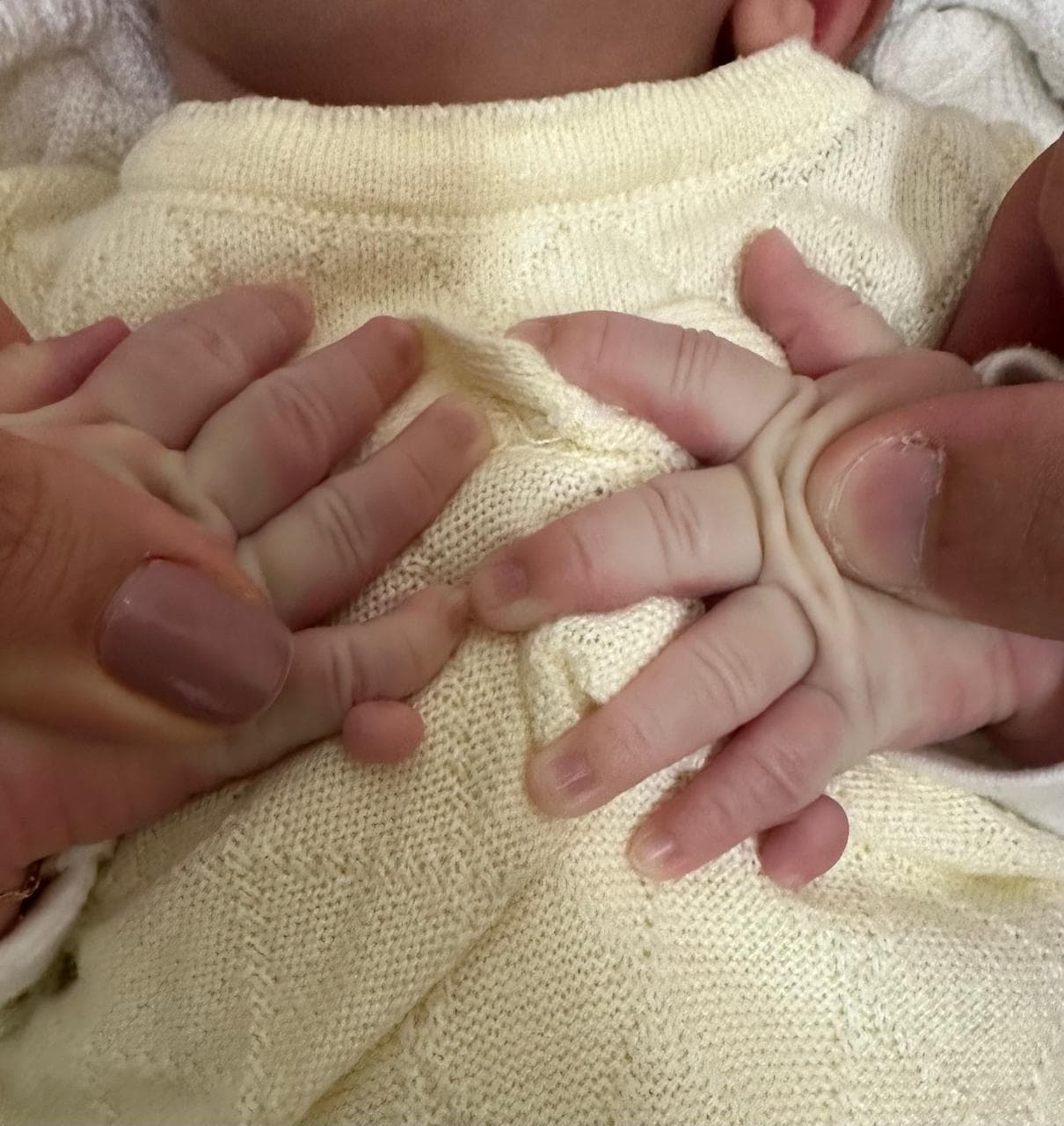 Polidactilia: dedinhos extras nas mãos de um bebê