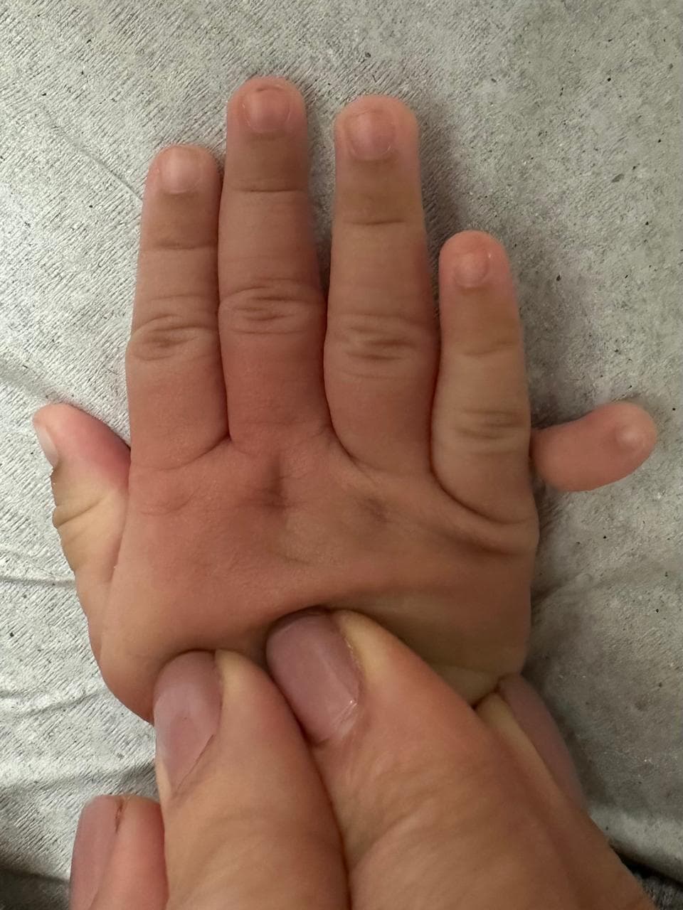 Polidactilia: dedo extranumerário na mão de uma criança