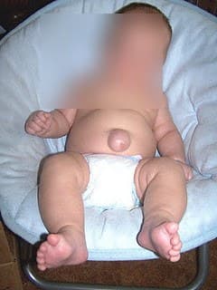 Hérnia umbilical em bebê: bolinha visível no umbigo, com o rosto embaçado