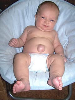 Hérnia umbilical em bebê: bolinha visível no umbigo