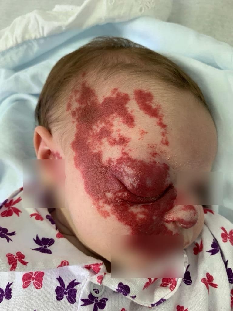 Hemangioma infantil segmentar na face de um bebê, com o rosto preservado