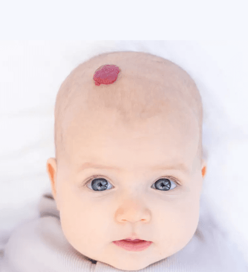 Hemangioma infantil em couro cabeludo