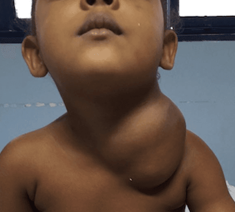 Malformação Linfática Cervical