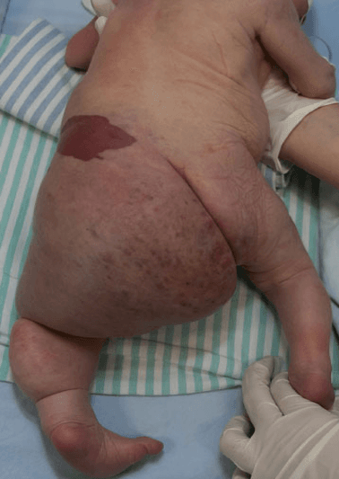 Malformação Vascular Complexa